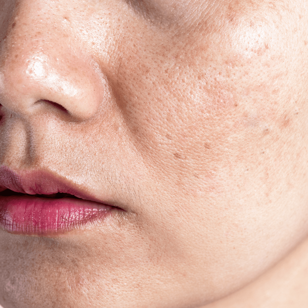 Hyperpigmentation