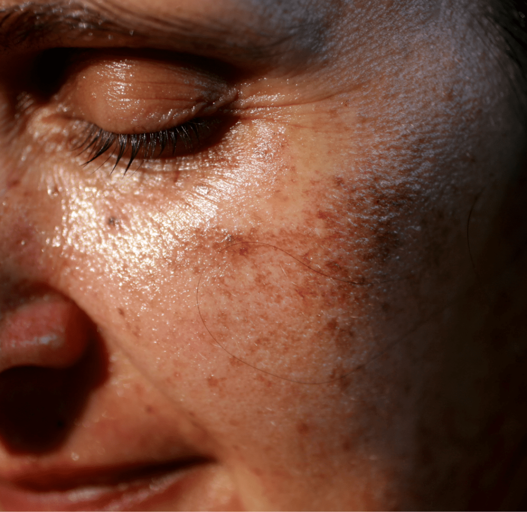 melasma & pigmentation