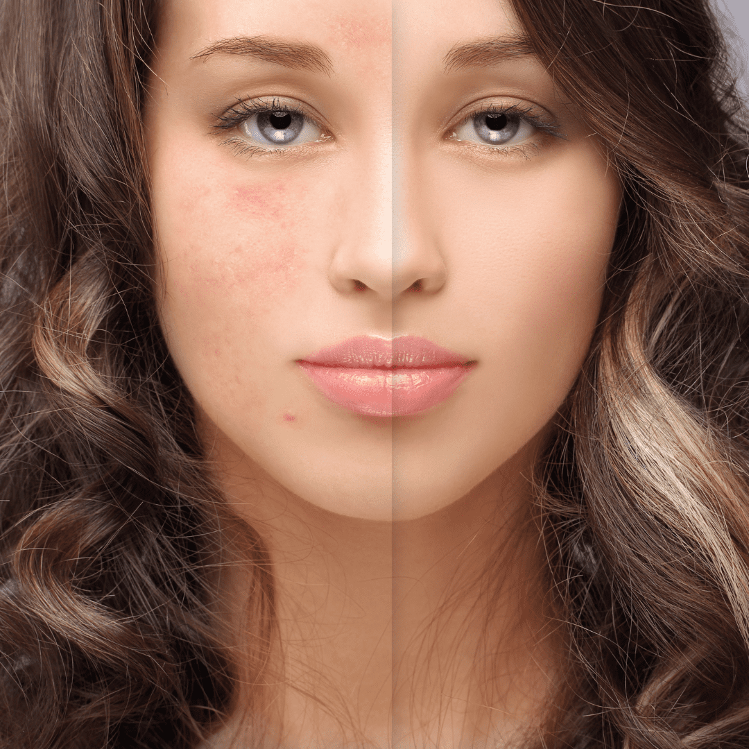 Anti Acne & Scar Treatment