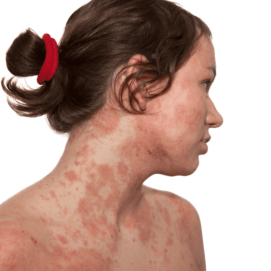 dermatitis