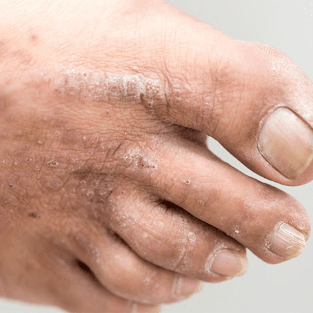 Eczema