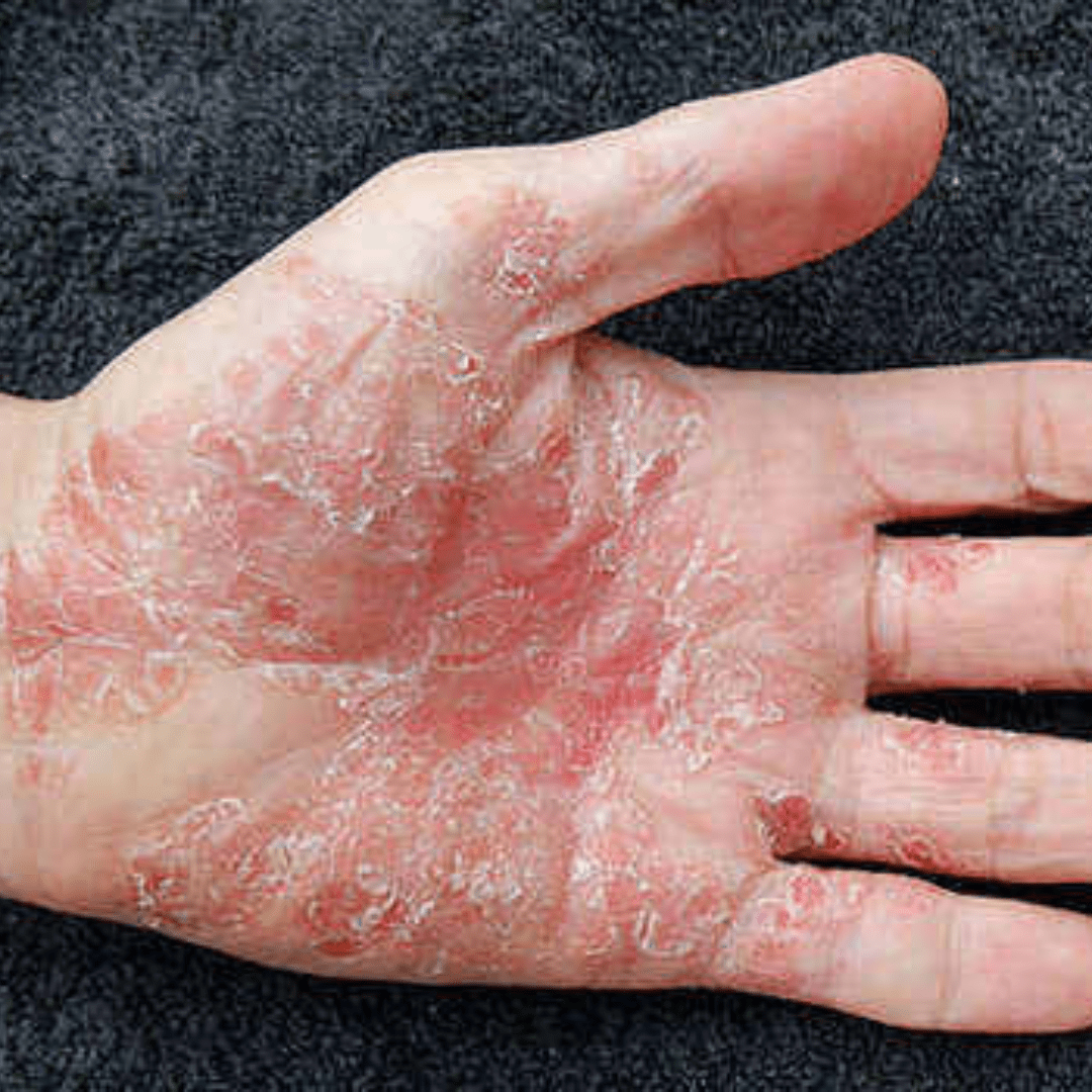 Psoriasis