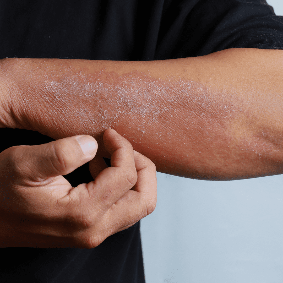 Skin allergies