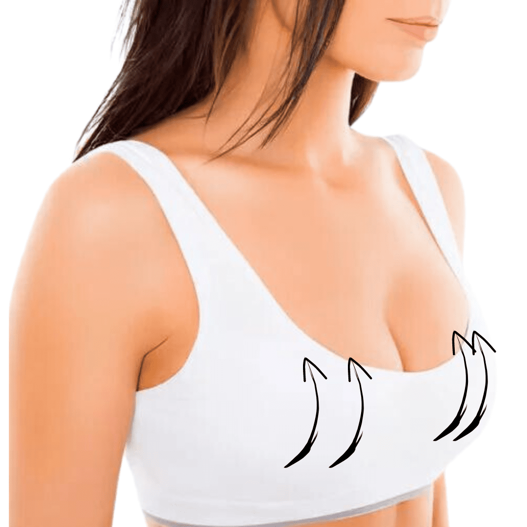 Breast Lift