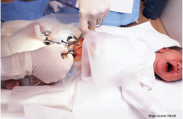 Circumcision Surgery