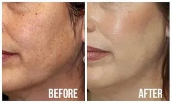 Microdermabrasion treatment
