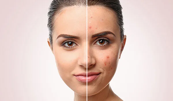 CO2 Fractional Laser treatment