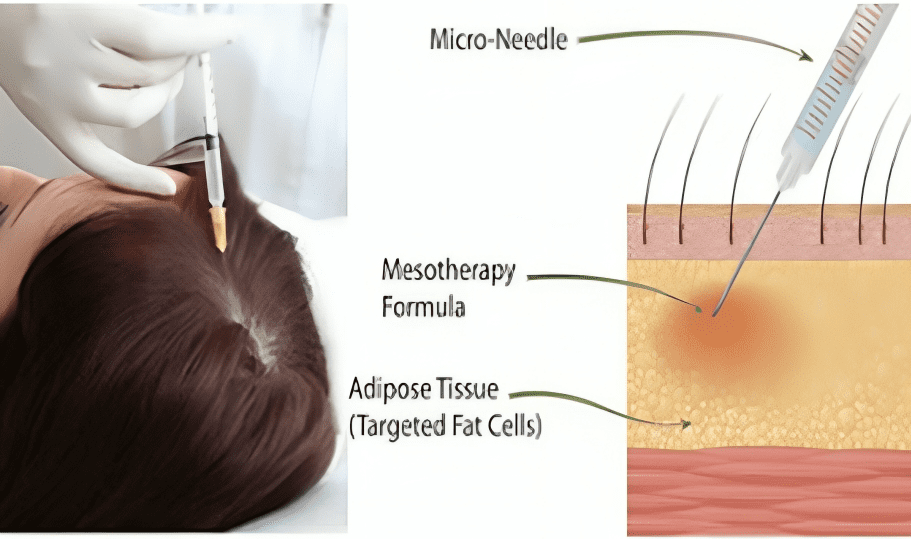 procedure of mesotherapy