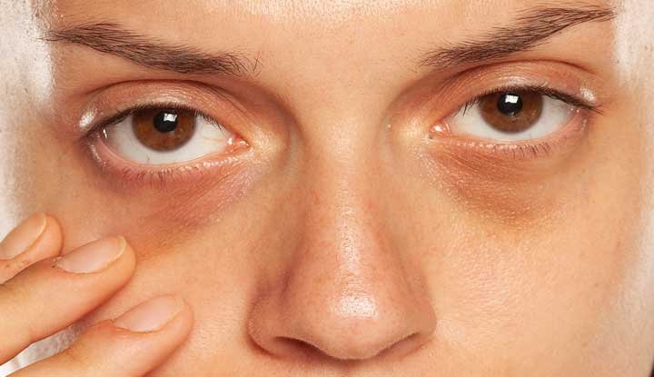 Dark Circles Concerns