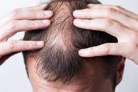 Hair Loss Concern