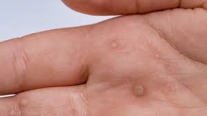 Warts concern