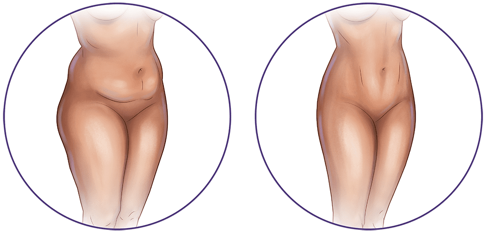 Liposuction Treatment