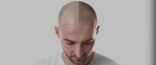 scalp micropigmentation